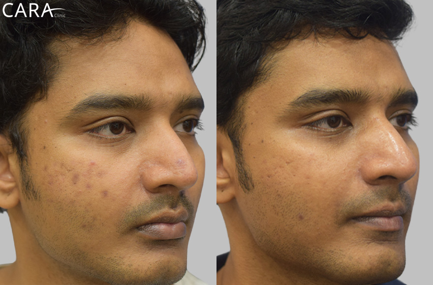 Transforming Skin Post-Acne with Targeted Treatments