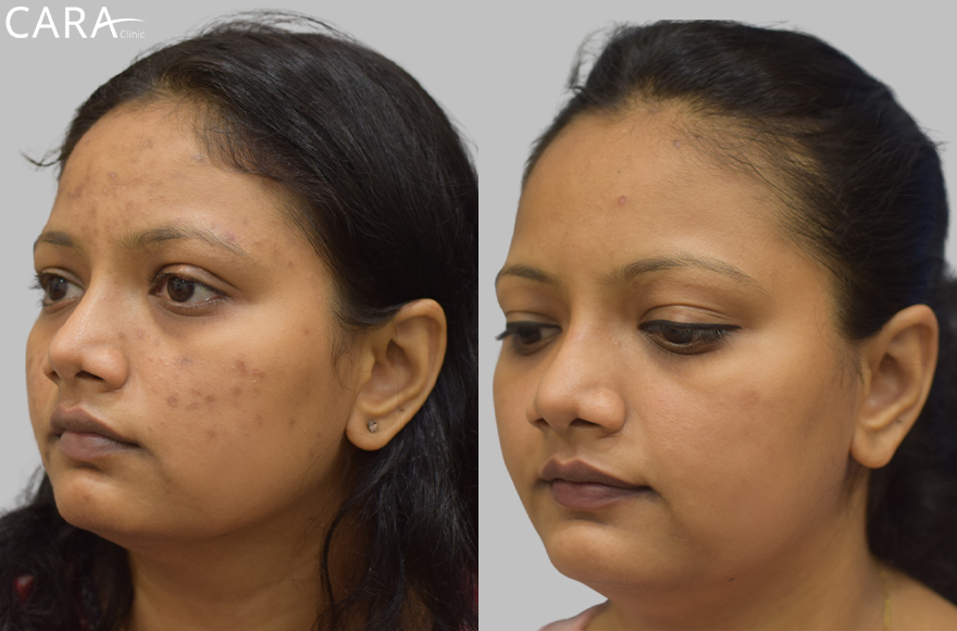 Effective Treatment for Post-Acne Hyperpigmentation
