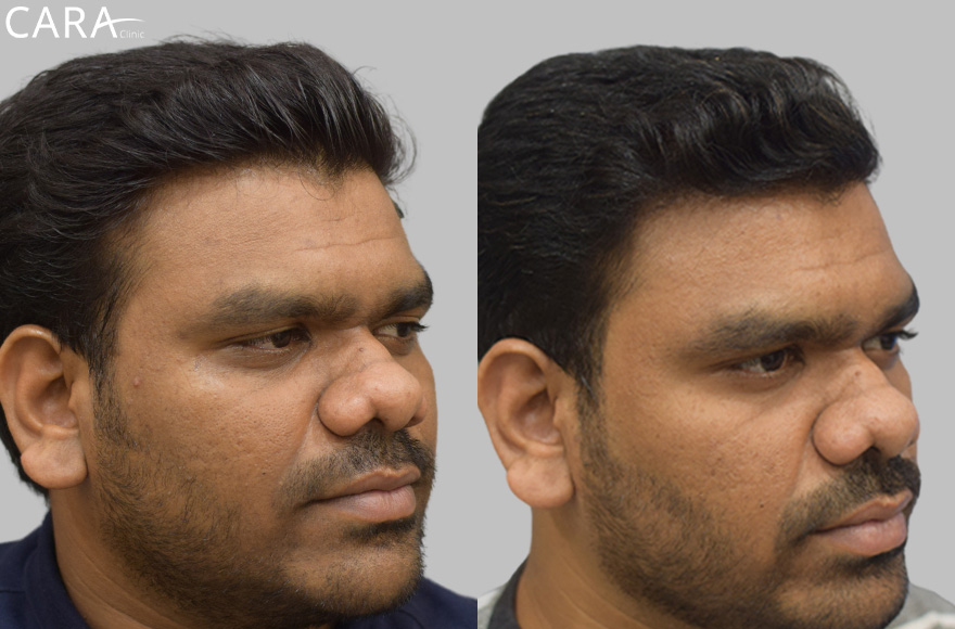 Transformation Through Cosmelan Treatment for Hyperpigmentation