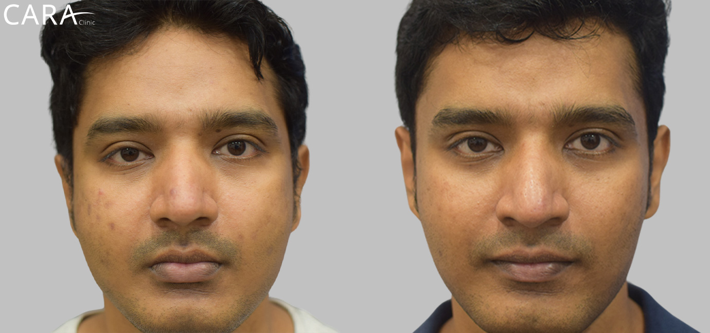 anti-pigmentation-treatment-ashwin