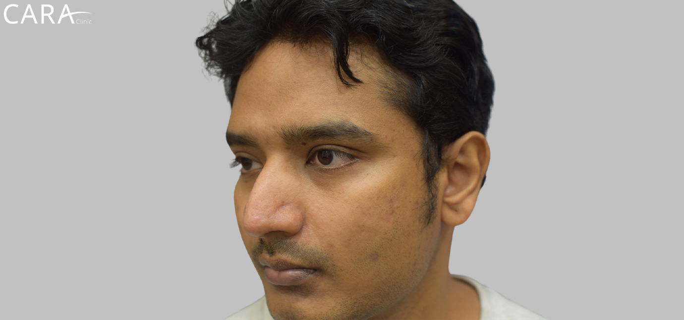 anti-pigmentation-treatment-ashwin