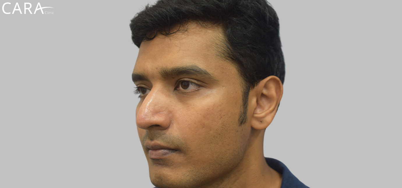 anti-pigmentation-treatment-ashwin