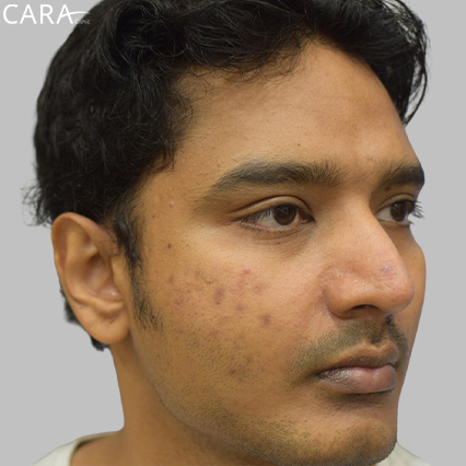 anti-pigmentation-treatment-ashwin