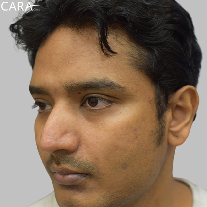 anti-pigmentation-treatment-ashwin