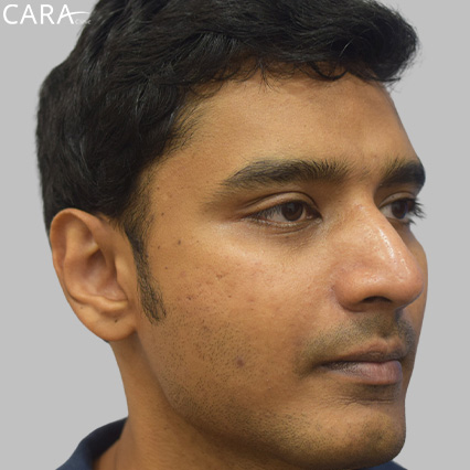 anti-pigmentation-treatment-ashwin
