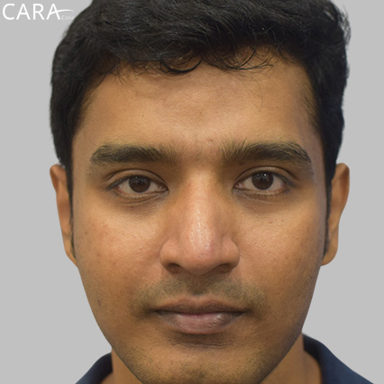 anti-pigmentation-treatment-ashwin