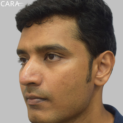 anti-pigmentation-treatment-ashwin